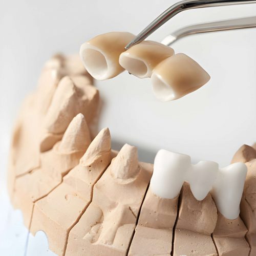 Dental Crowns 2